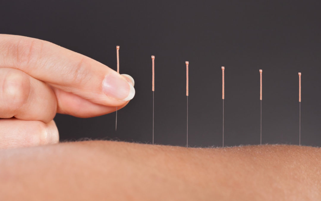 Let’s learn about Acupuncture and Cupping!